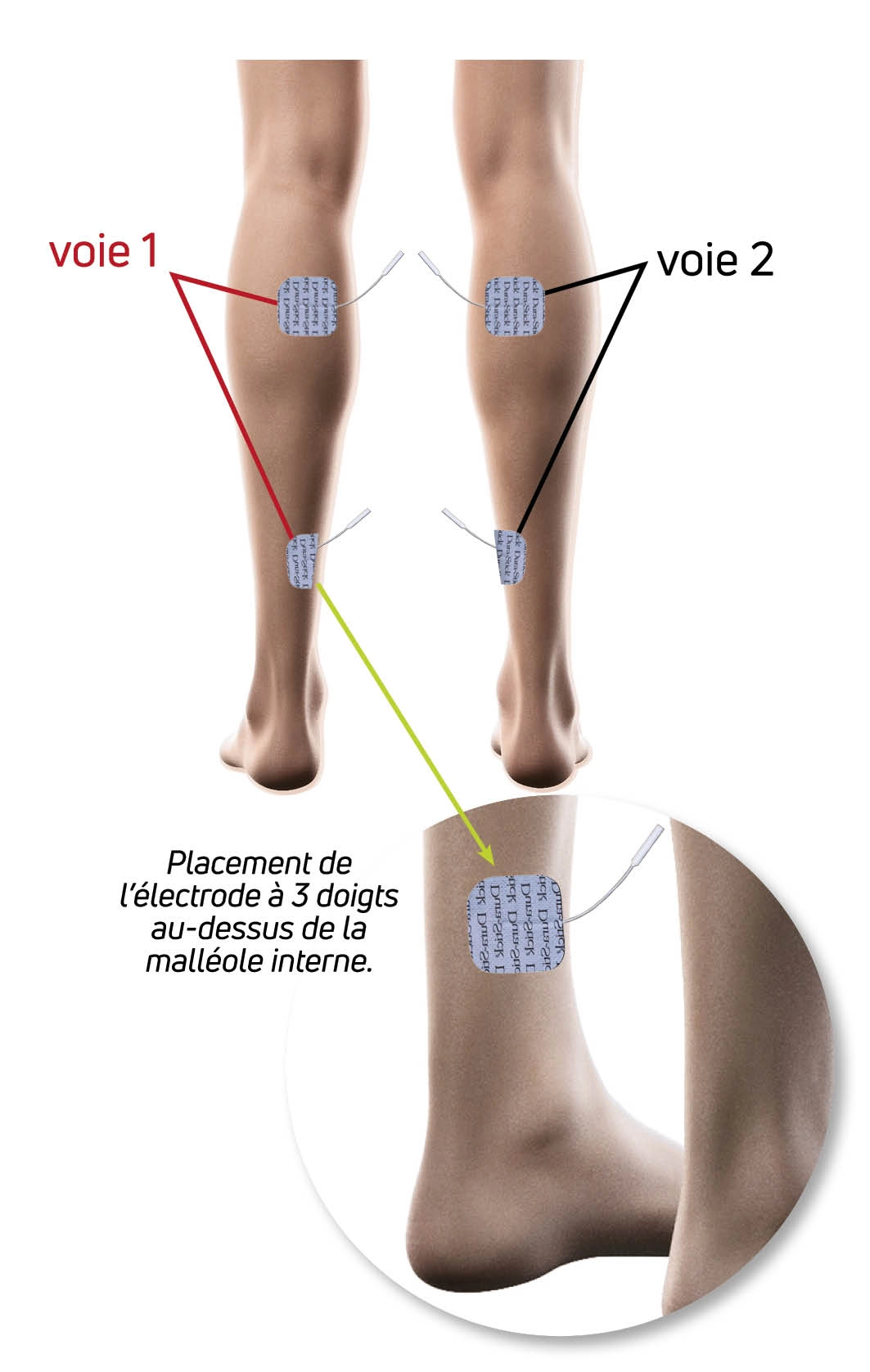 Soulagez le Syndrome des Jambes Sans Repos avec l'Électrostimulation TENS movaleo